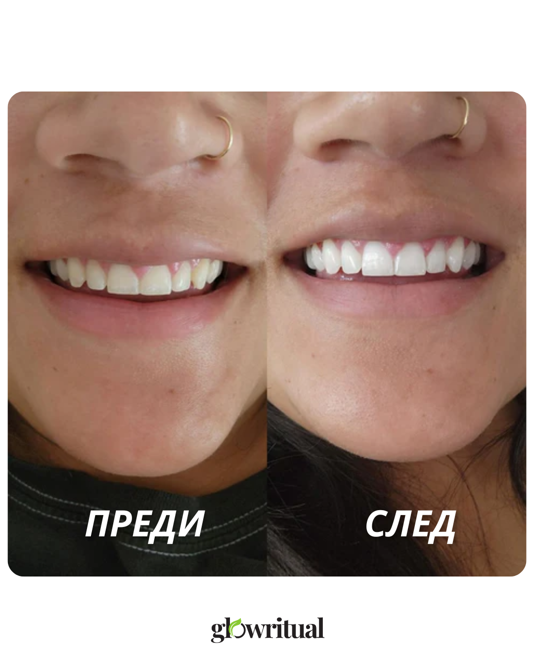 GlowSmile Ленти – Избелващи лентички за зъби